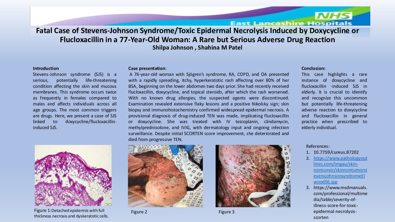 Fatal Case of Stevens-Johnson Syndrome/Toxic Epidermal Necrolysis Induced by Doxycycline or Flucloxacillin in Elderly poster preview image