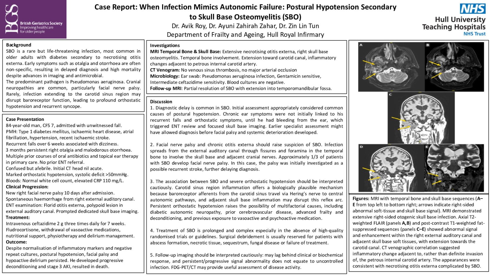 When infection mimics autonomic failure:Postural hypotension secondary to skull base osteomyelitis   poster preview image